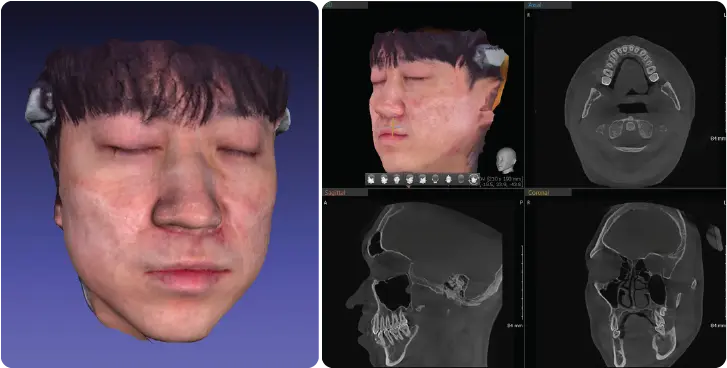 디지털 보철 CAD/CAM 워크플로우